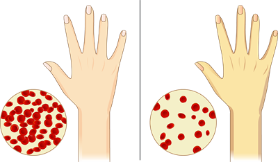 YCIND_220615_3907_anemia and normal blood.png