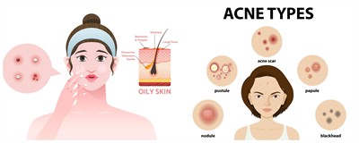 acne.jpg
