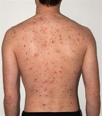 791px-Chickenpox_Adult_back.jpg