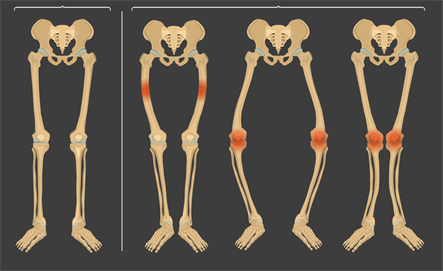 Bones rickets.png
