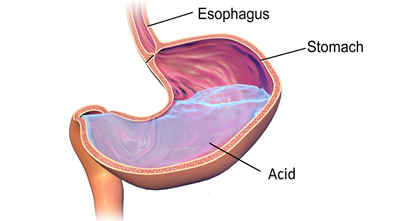 GERD.png