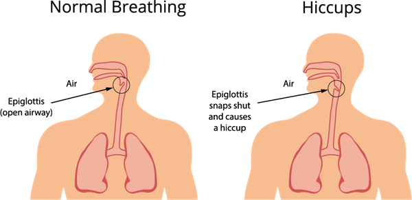 Hiccups.png