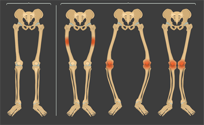 Bones rickets.png