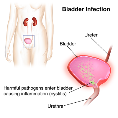 Bladder_Infection.png