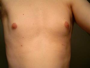 20060726_supernumerary_nipples.jpg