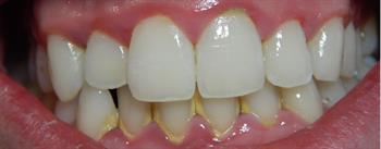 Gingivitis-before.jpg