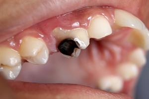 800px-Dental_Caries_Cavity_2.jpg