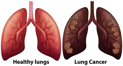 lungs.jpg