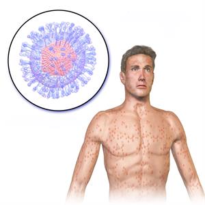 Chicken_Pox_(Varicella_Zoster).jpg