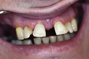 800px-Zahnwanderung_wegen_Periodontitis_OK_05.jpg