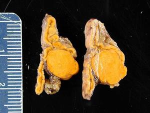 512px-Adrenal_gland_Conn_syndrome4.jpg